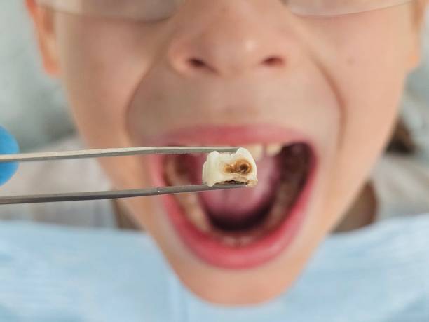 Best Dental Abscess Treatment in Caddo, OK